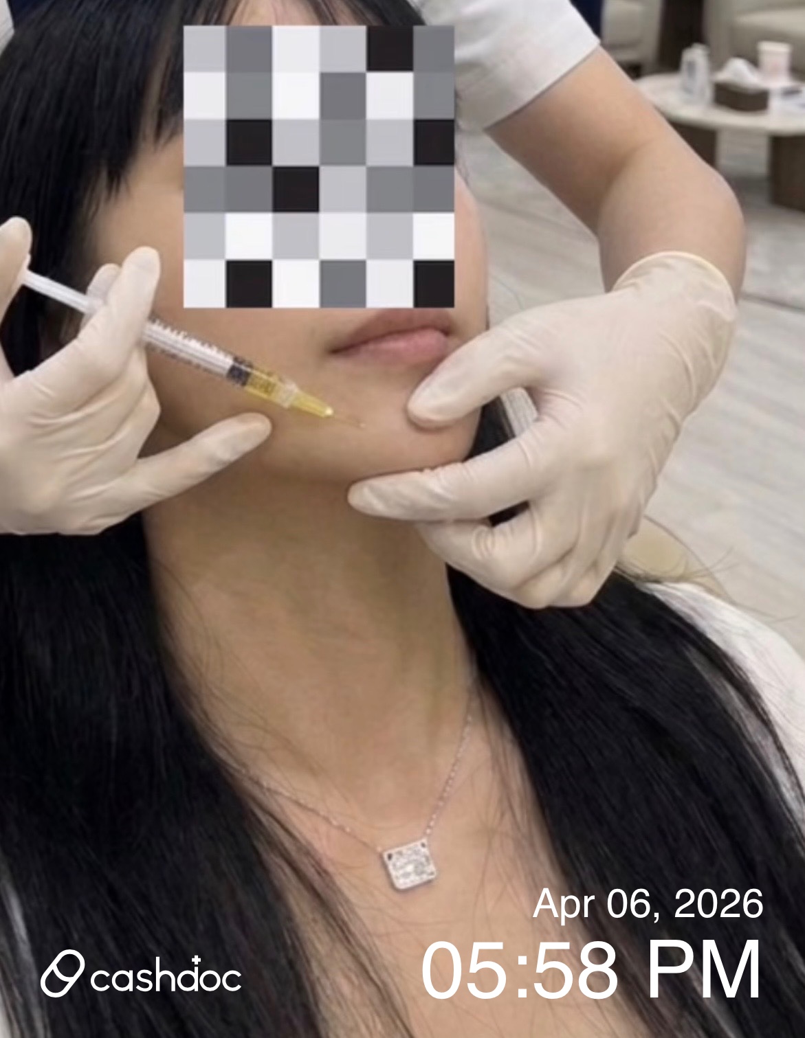 창원이루다성형외과에서 부담 없는 첫 보톡스 경험