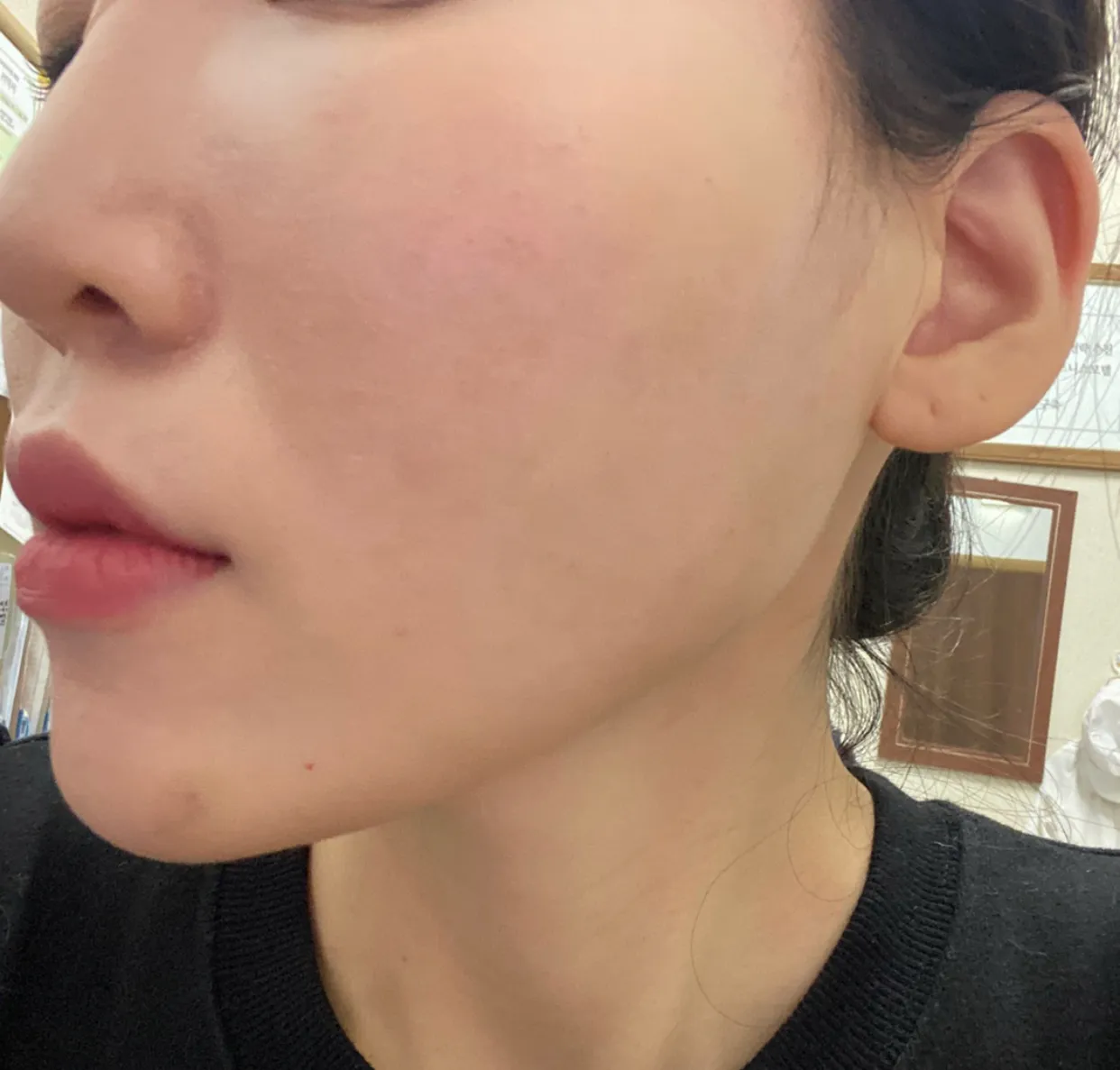 After treatment — Pain reduction special #Rejuran Healer
