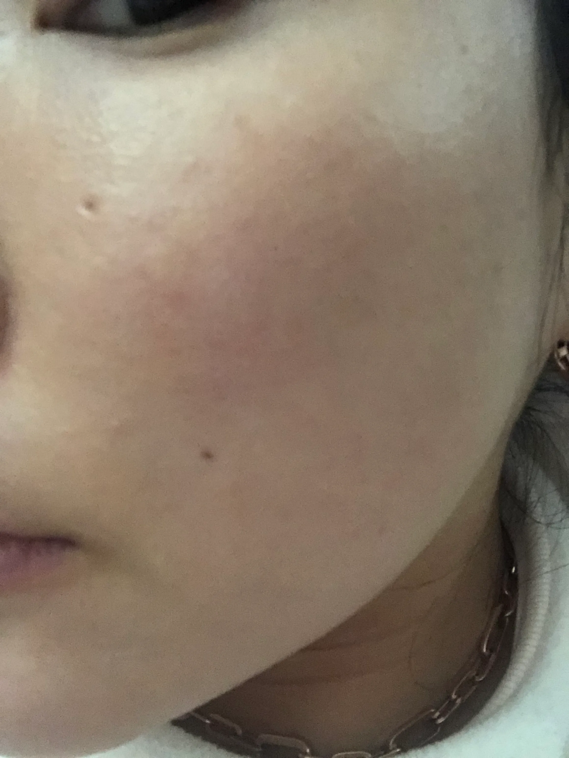 Before treatment — Pain-Reducing Special Offer #Rejuran Healer