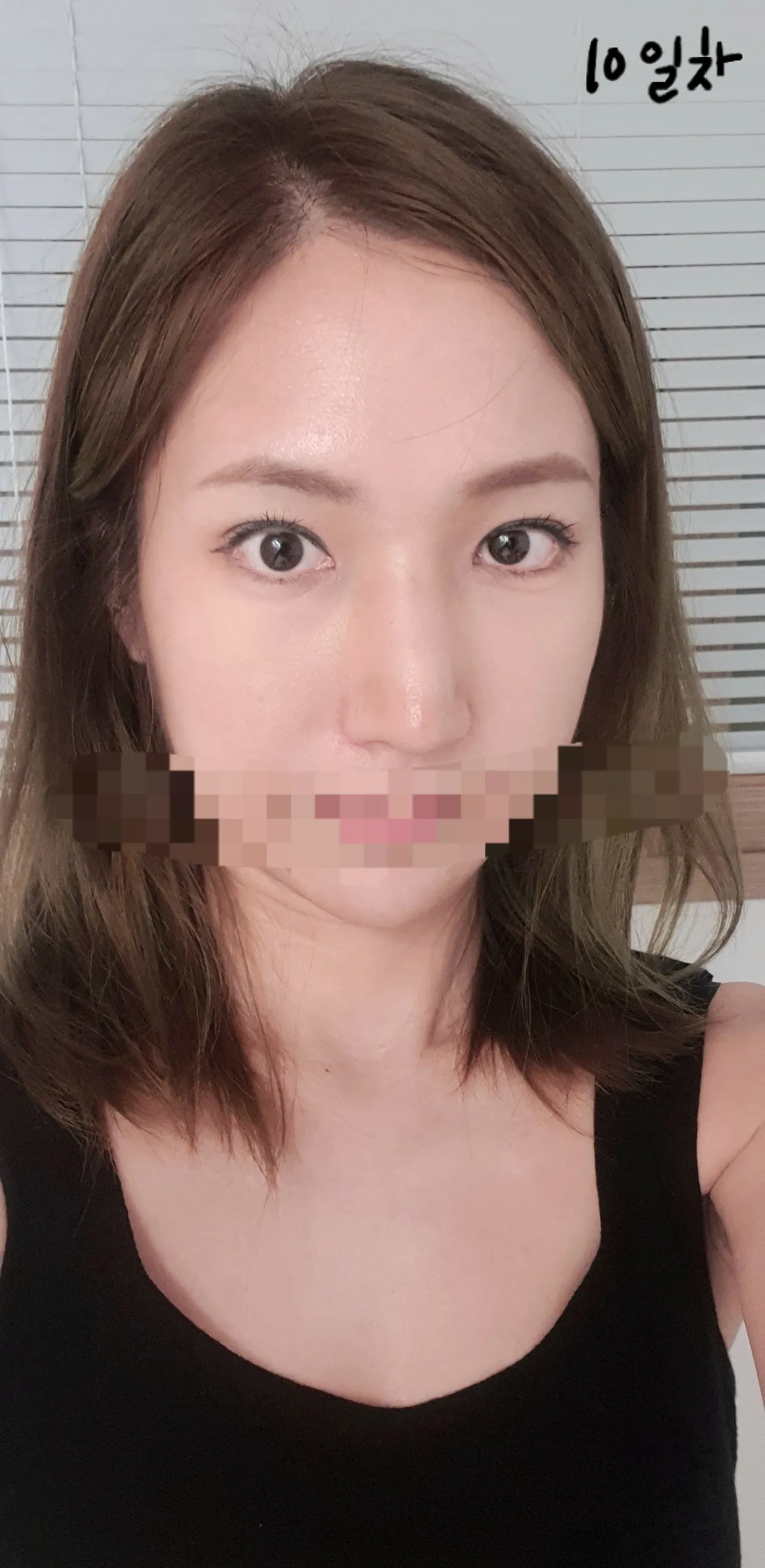 시술 후 — 말랑말랑 무보형물 코성형