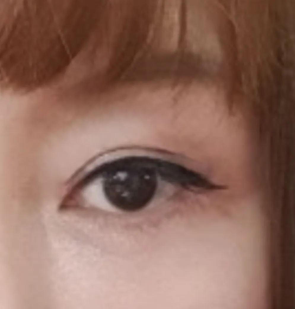 시술 후 — 눈매교정 