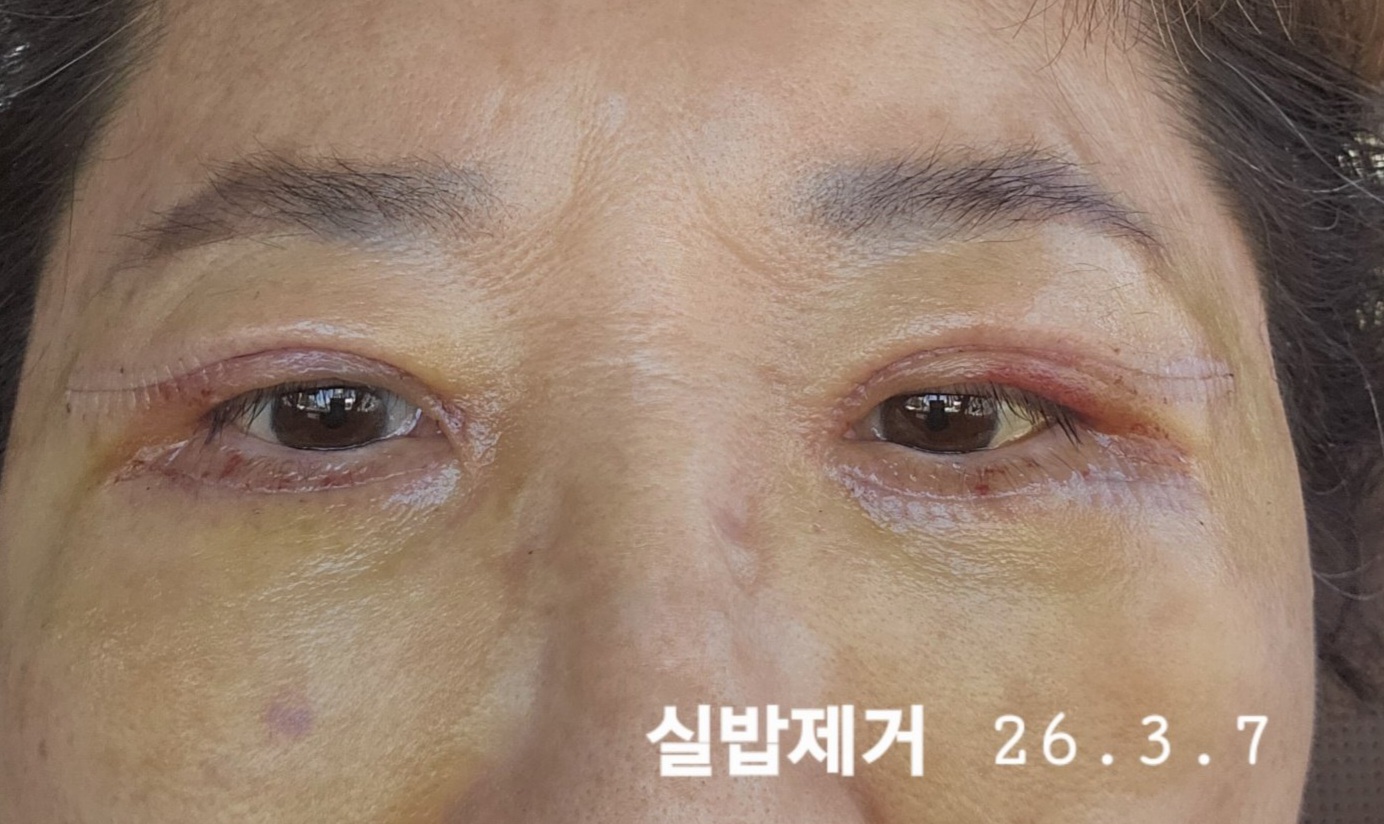 서구 시티성형외과의원, 상하안검 시술 후기입니다