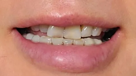 Before treatment — 30-Minute Complete Teeth Whitening Program