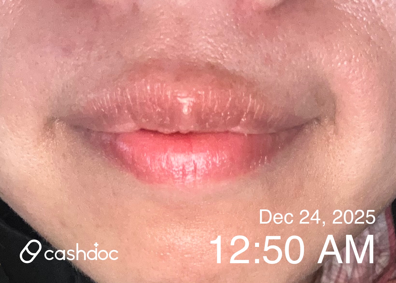 파주 스노우의원에서 친절하고 아픔 덜한 인중 제모 경험