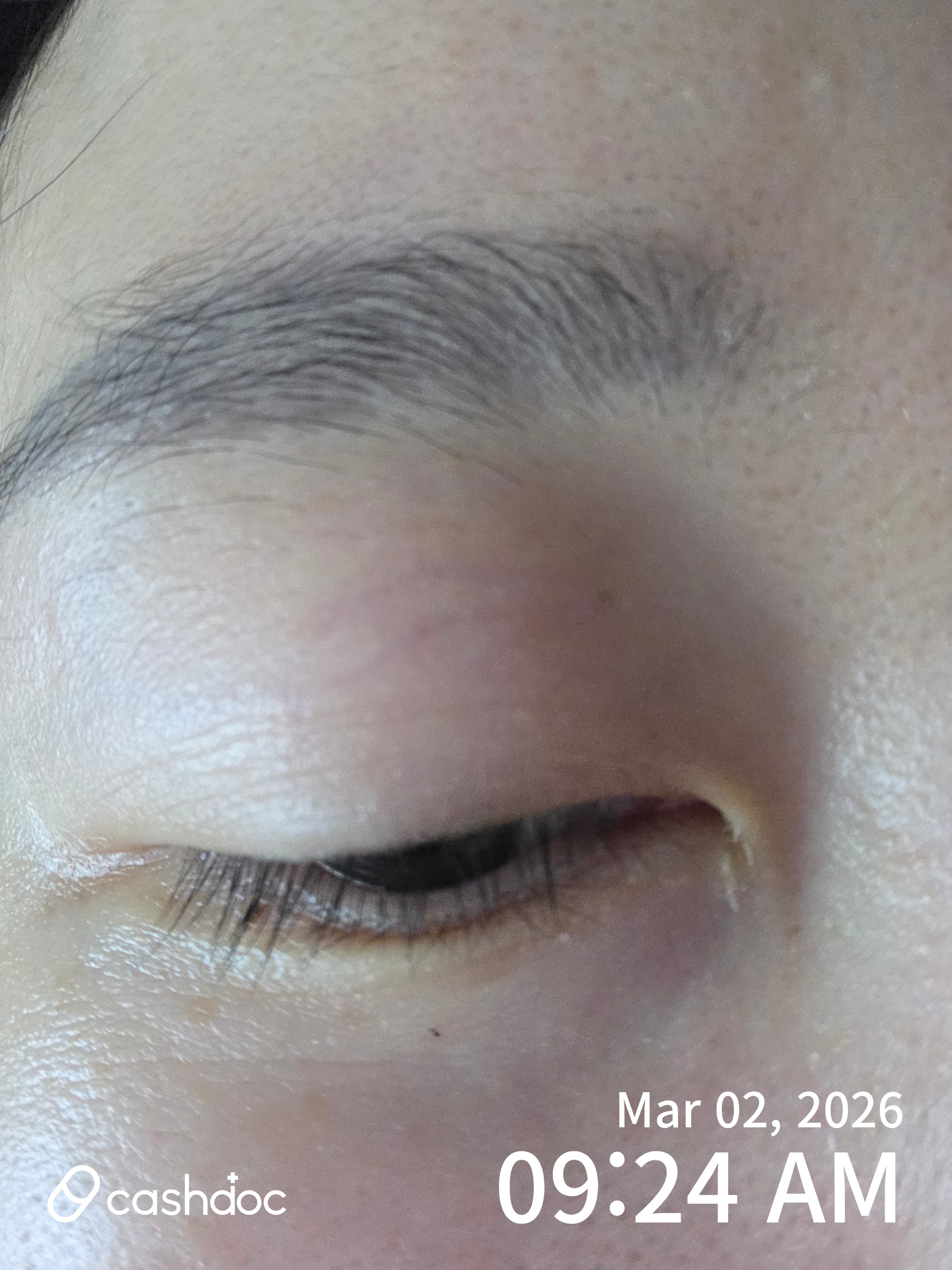 서초구 수연세안과의원 라섹 후 검진, 건조증은 아직 남았지만 만족스러워요