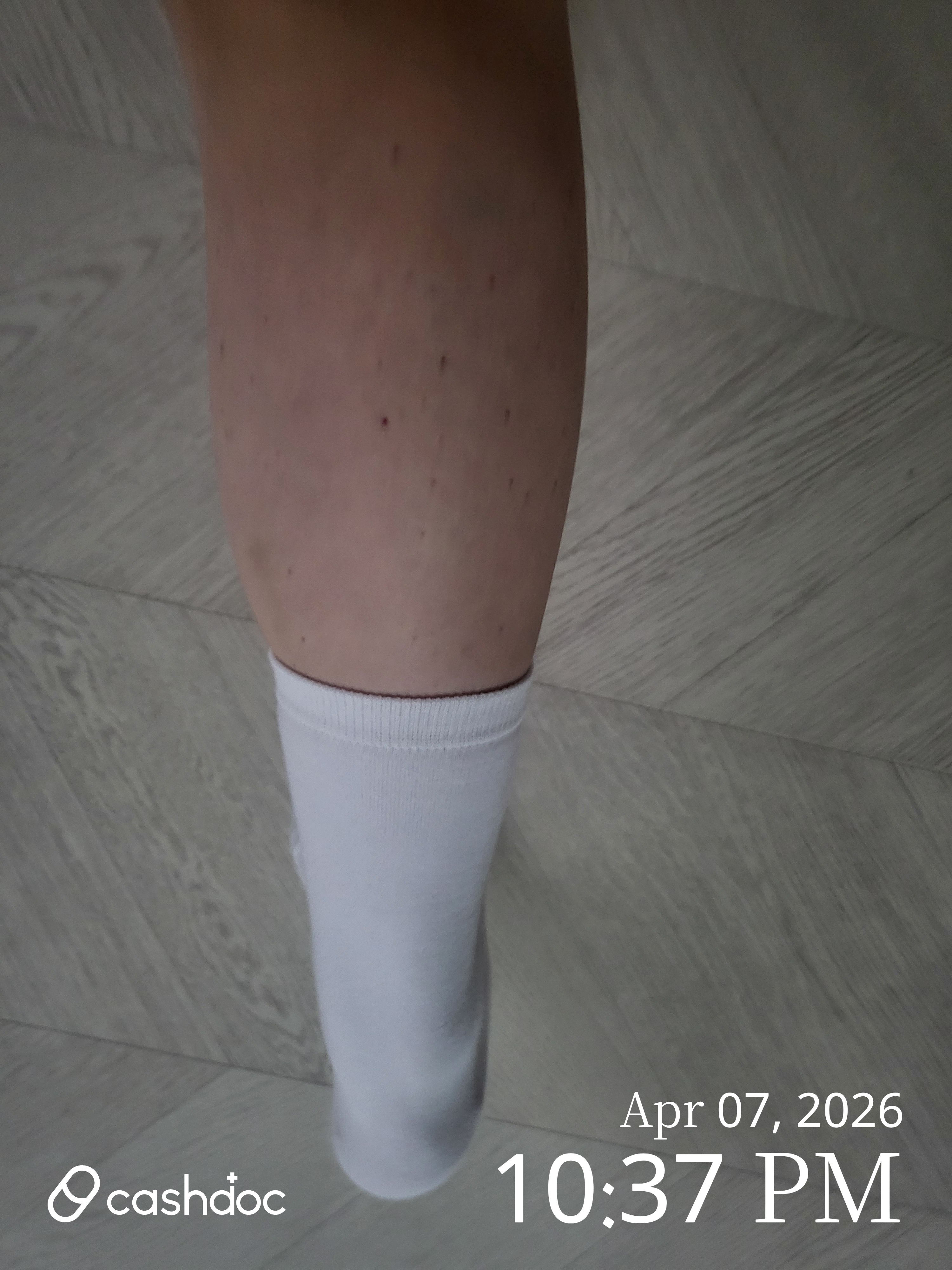 성남시 메이퓨어의원에서 컷슬린으로 종아리 슬림 기대감