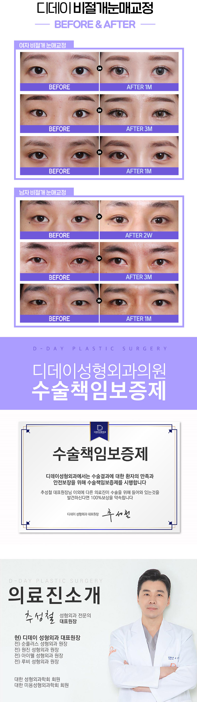 디데이성형외과의원 디데이💖비절개눈매교정 이벤트, 시술 상세 이미지