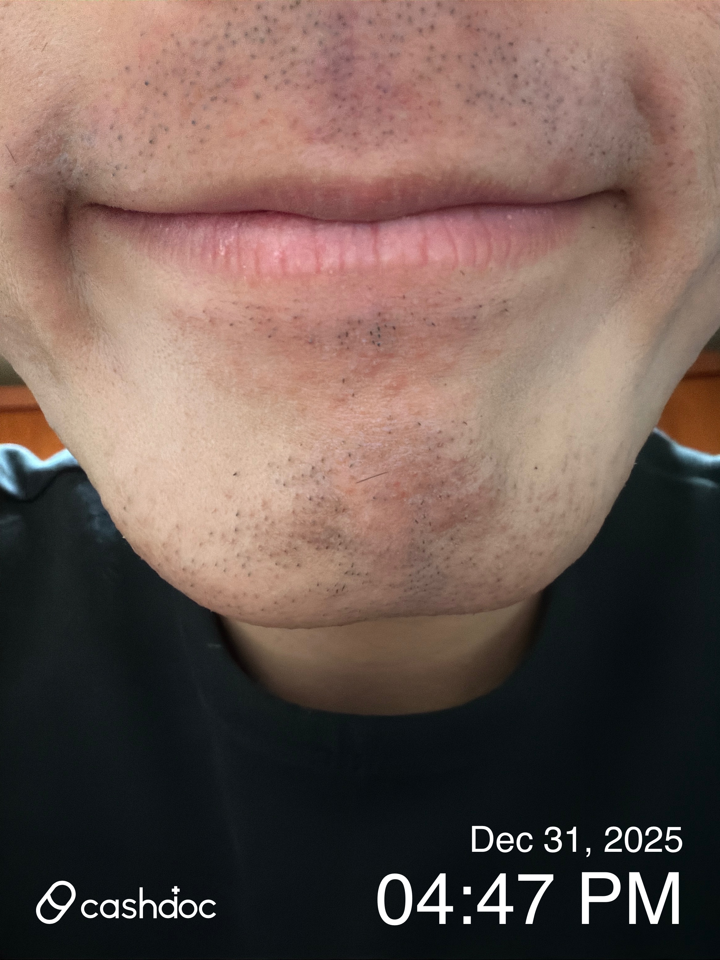 수성구 유니티의원, 레이저제모 체험 만족스러워요