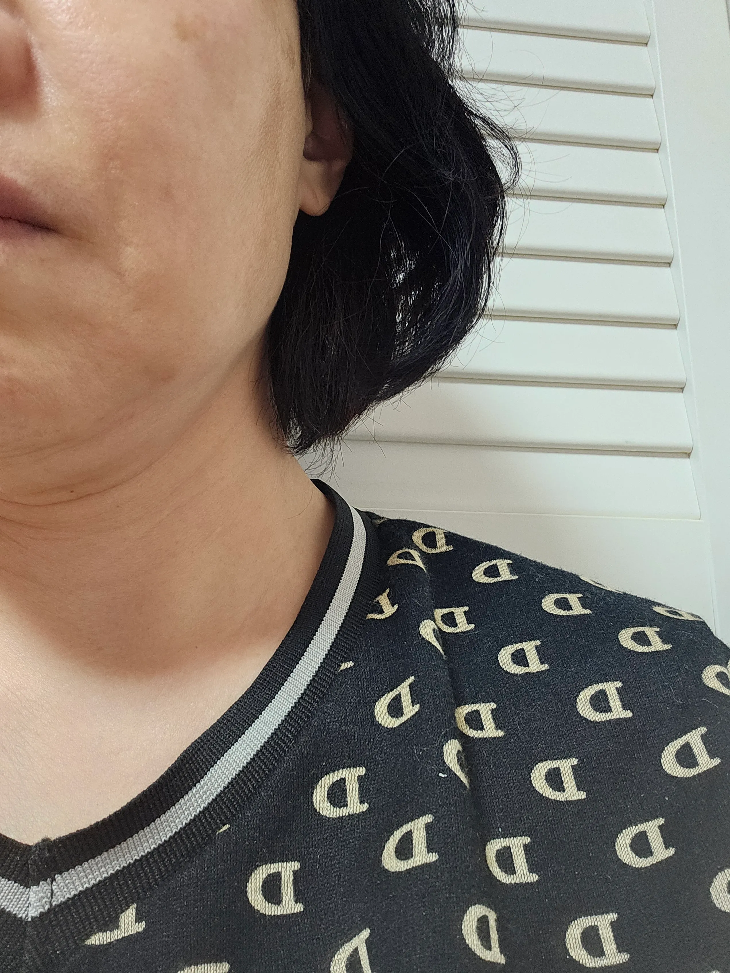 시술 후 — 미케이 기미&주근깨 개선_레이저토닝