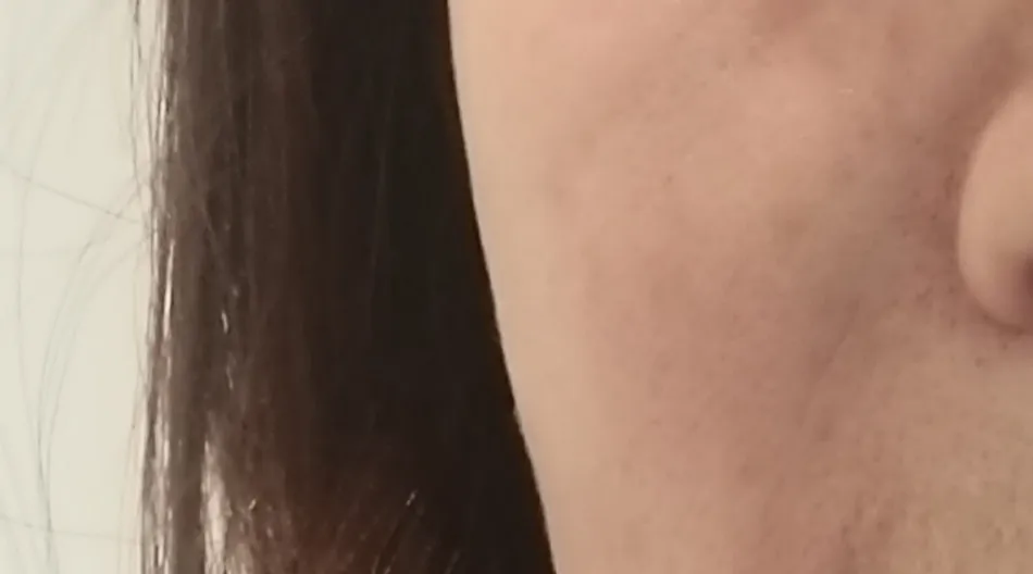 项目前 — 皮肤再生#皮肤弹性#对抗细纹的瑞姿填充剂