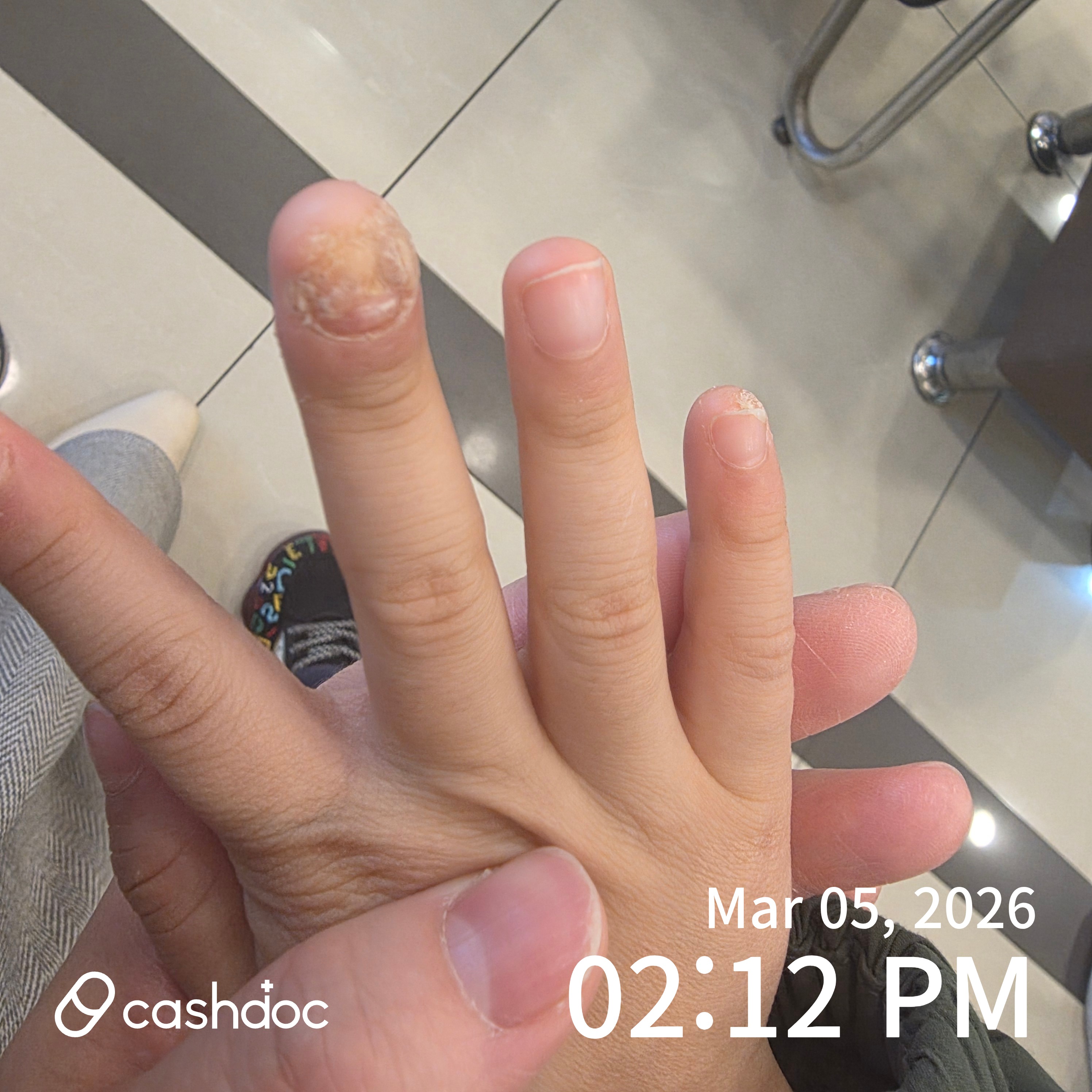 울산 남구 하늘마음한의원에서 아이 사마귀 치료 후기