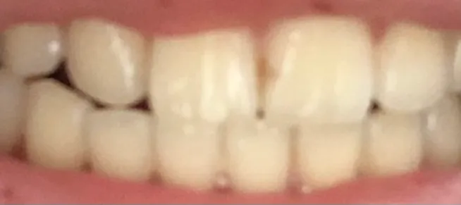 Before treatment — Teeth whitening, really! ♥ 39,000 won ♥