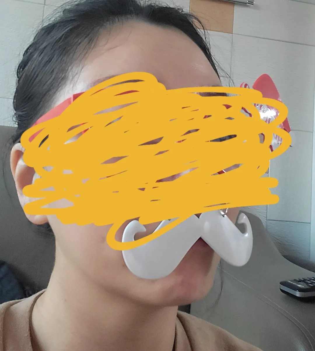시술 전 — 미케이 맞춤 필러_입술, 턱끝, 팔자
