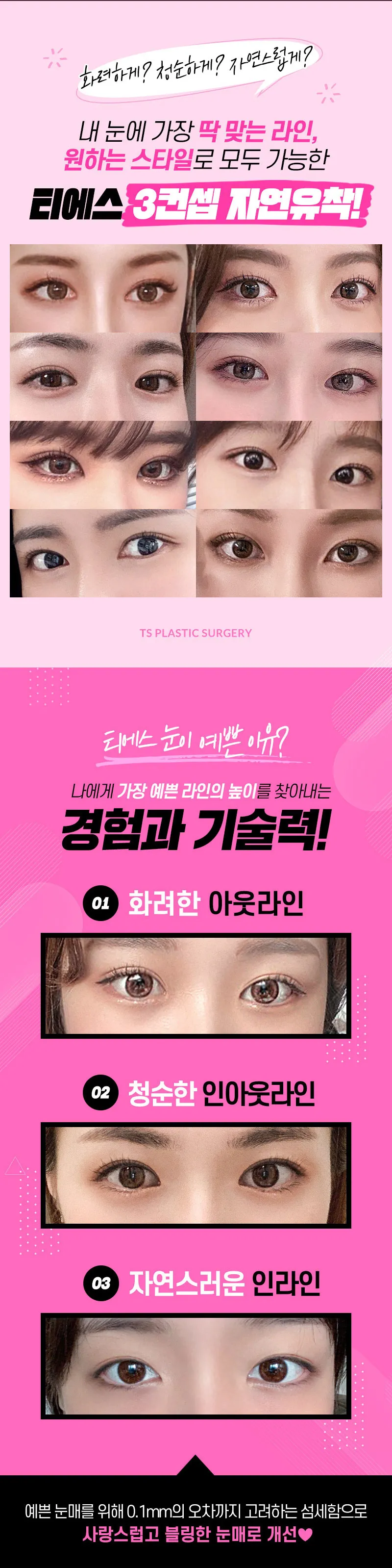 티에스성형외과 티에스 첫눈 3컨셉 자연유착 이벤트, 시술 상세 이미지