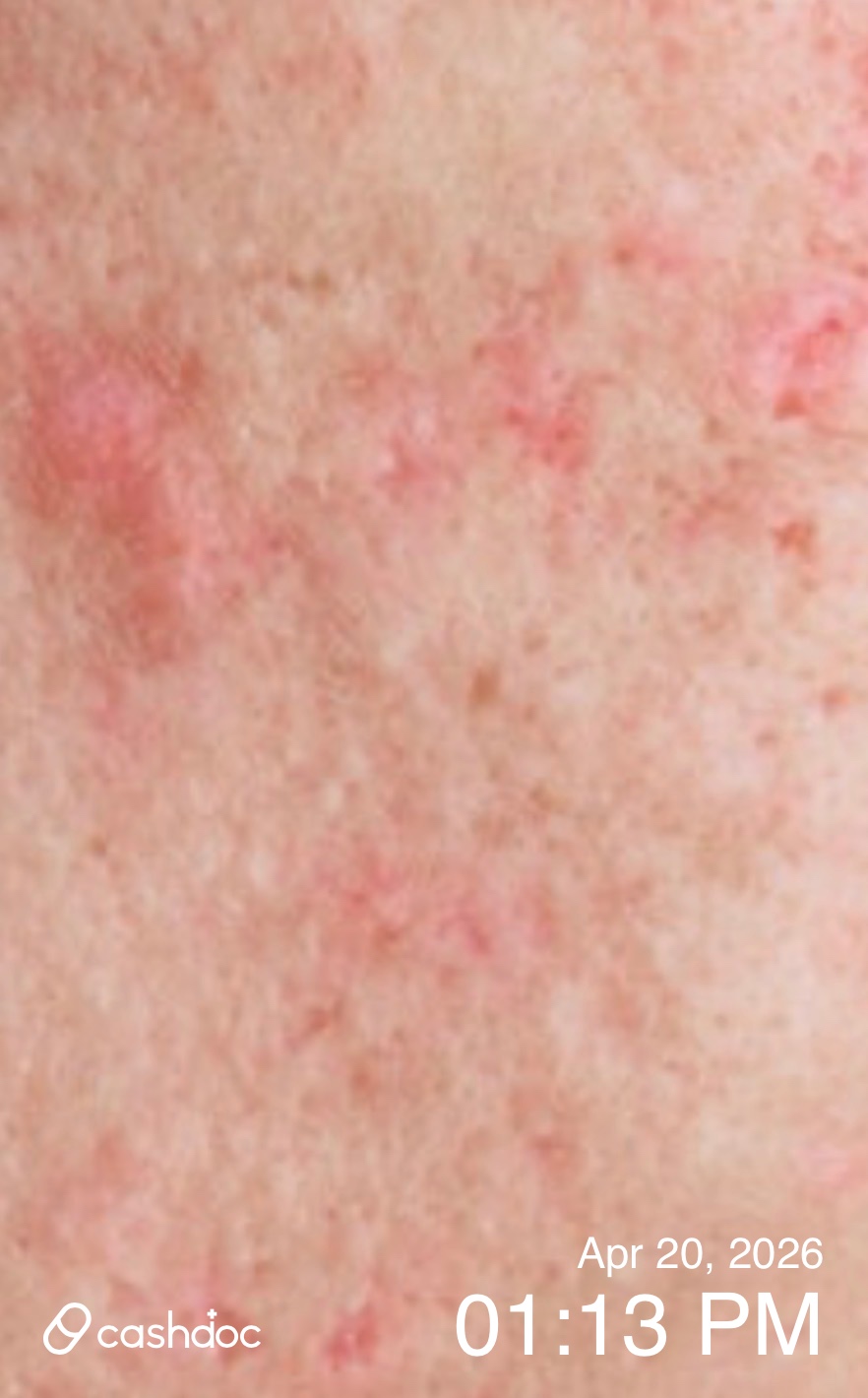 수원시 유앤미피부과에서 여드름 치료 후 만족스러워요