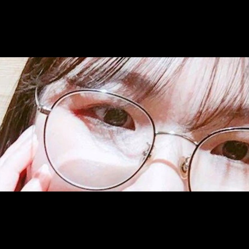 시술 전 — 1mm 숨은 공간까지! 오픈아이 트임