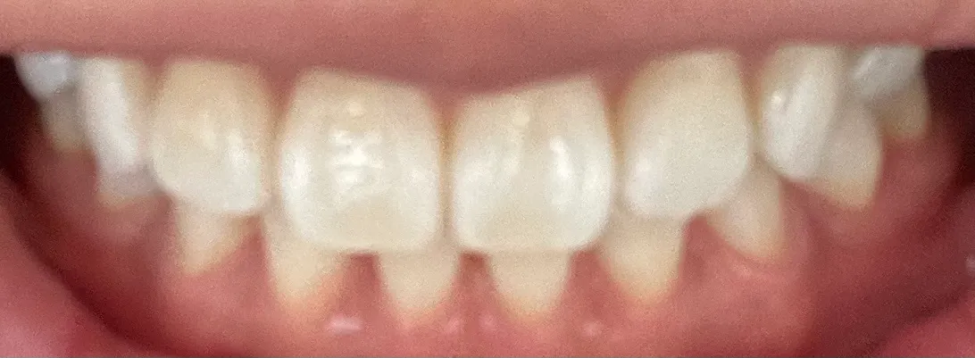After treatment — 30-Minute Complete Teeth Whitening Program