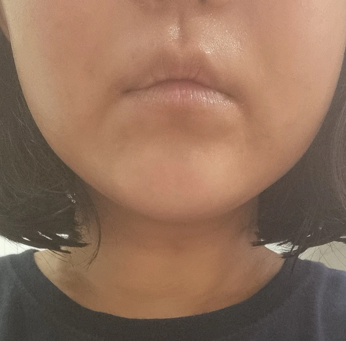 施術後 — ナノフェイス脂肪吸引