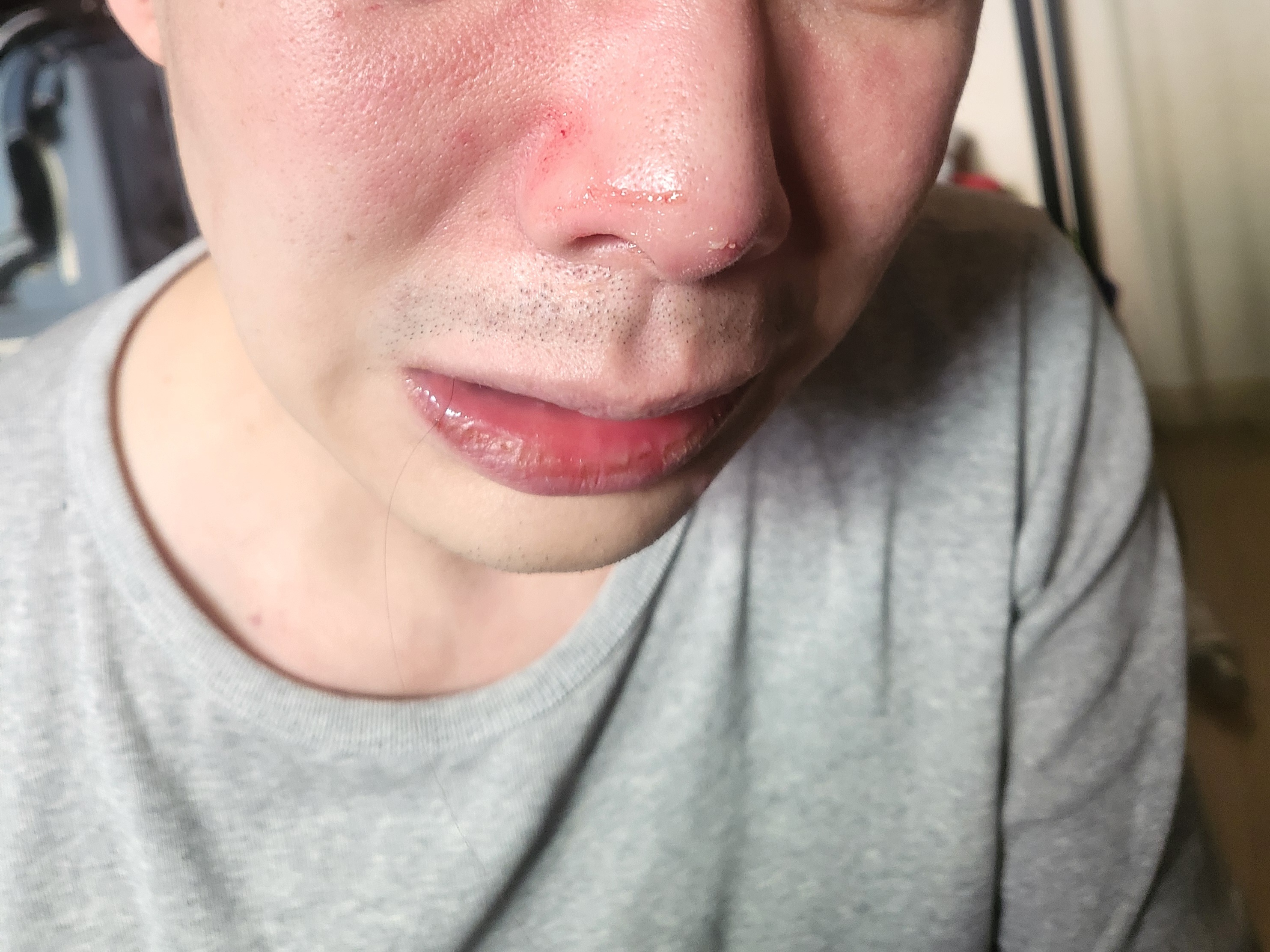 오산시 김피부과의원에서 염증 반복, 이제 열심히 치료 시작!