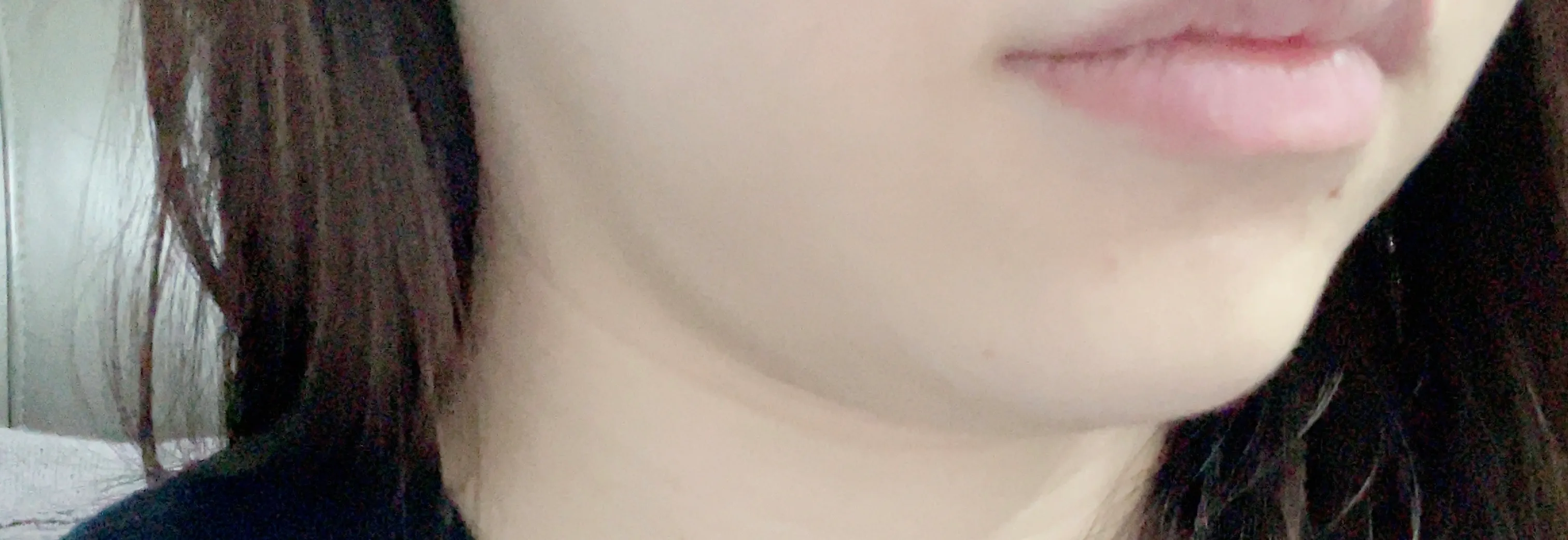 시술 전 — 튀어나온 턱라인 정리. 침샘보톡스