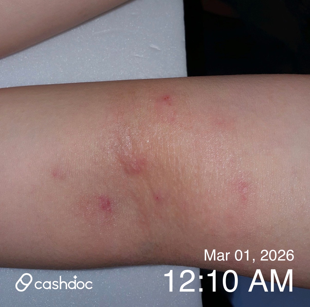 강남구 민앤민의원에서 아토피 치료 후기 공유합니다