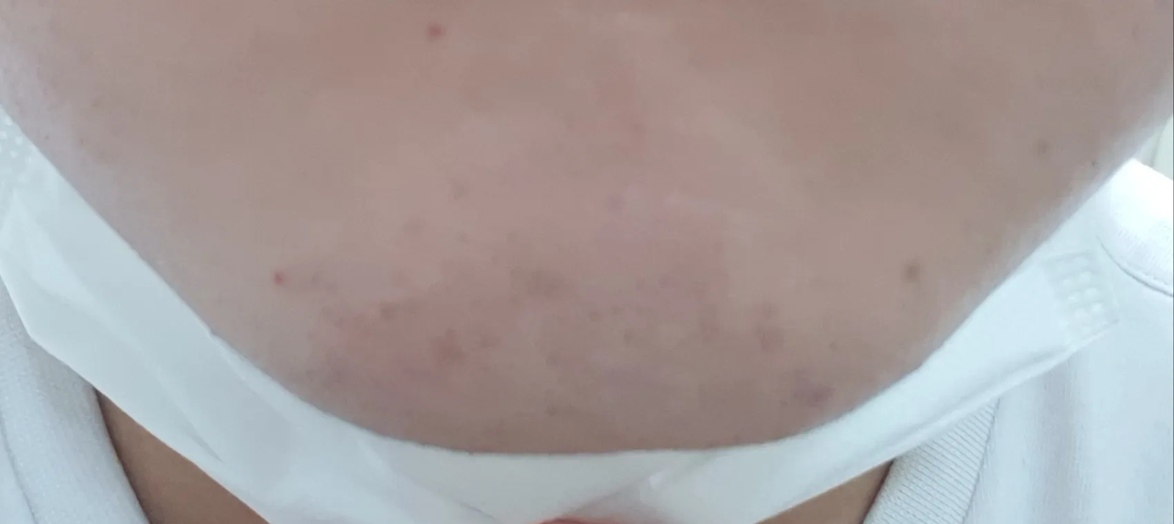 施術後 — 男性用RAZR脱毛