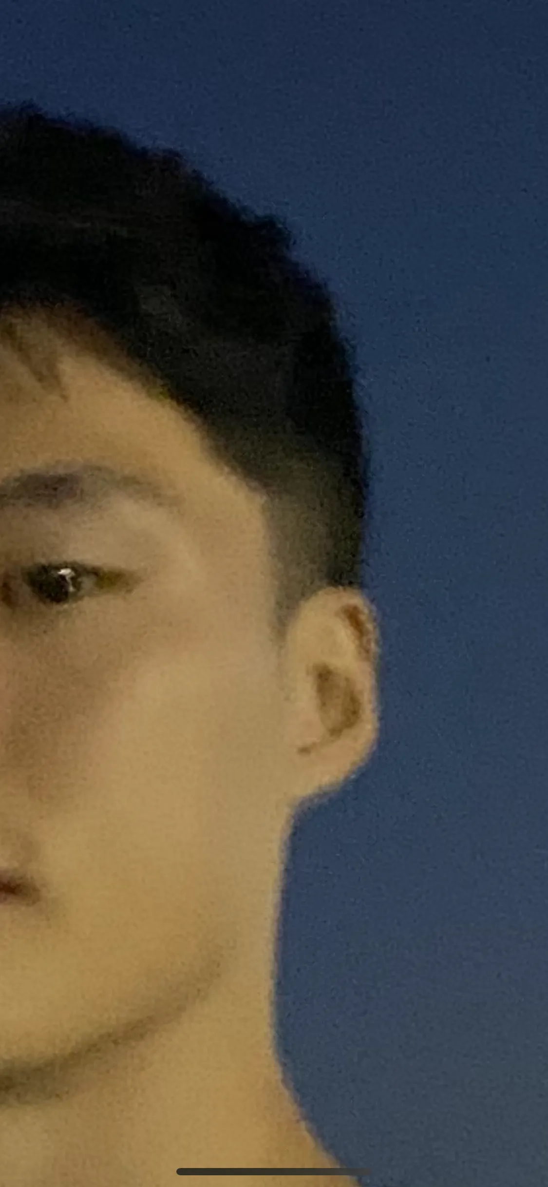 시술 전 — 포텐자 모공레이저 / MLA 프락셀