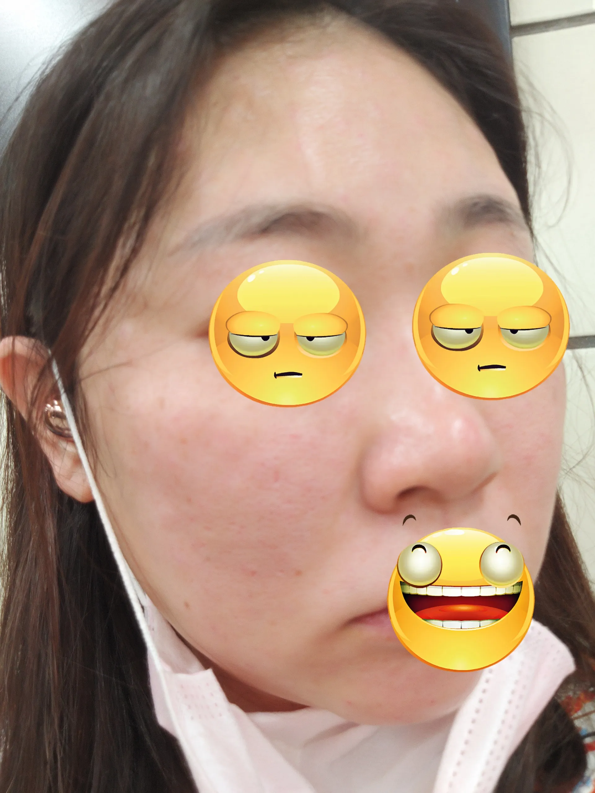 Before treatment — ★ Rejuran Healer 7.9 ★ Pore Reduction, Skin