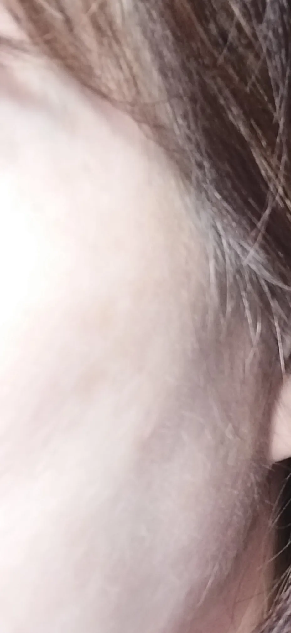 After treatment — Pride Rejuran HB+