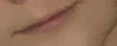 시술 전 — 입술필러&입꼬리 보톡스