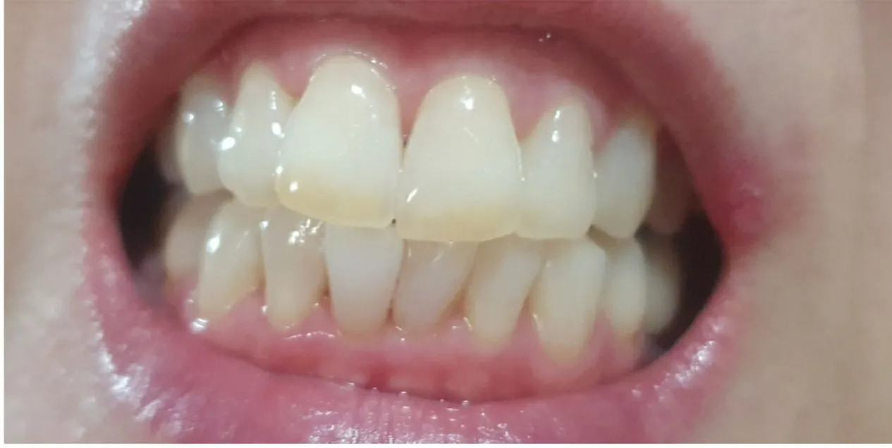 After treatment — Teeth whitening, really! ♥ 39,000 won ♥