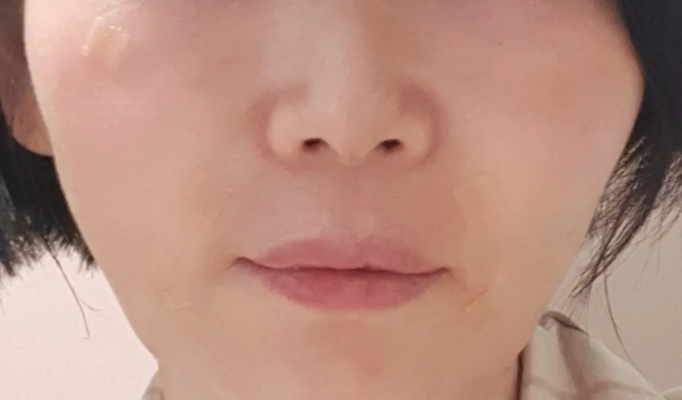 시술 후 — 미케이 주름&사각턱 보톡스