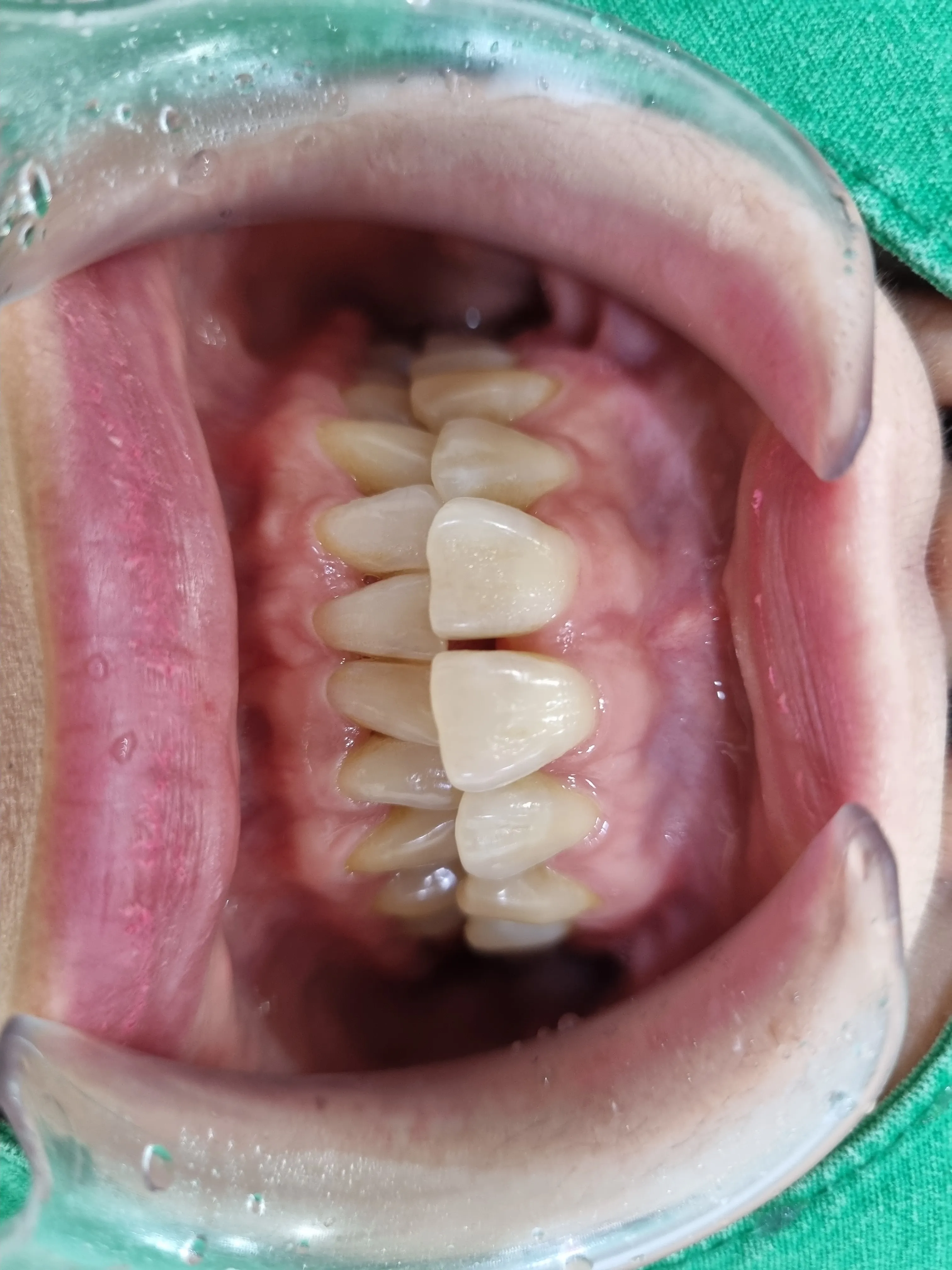 Before treatment — 30-Minute Complete Teeth Whitening Program