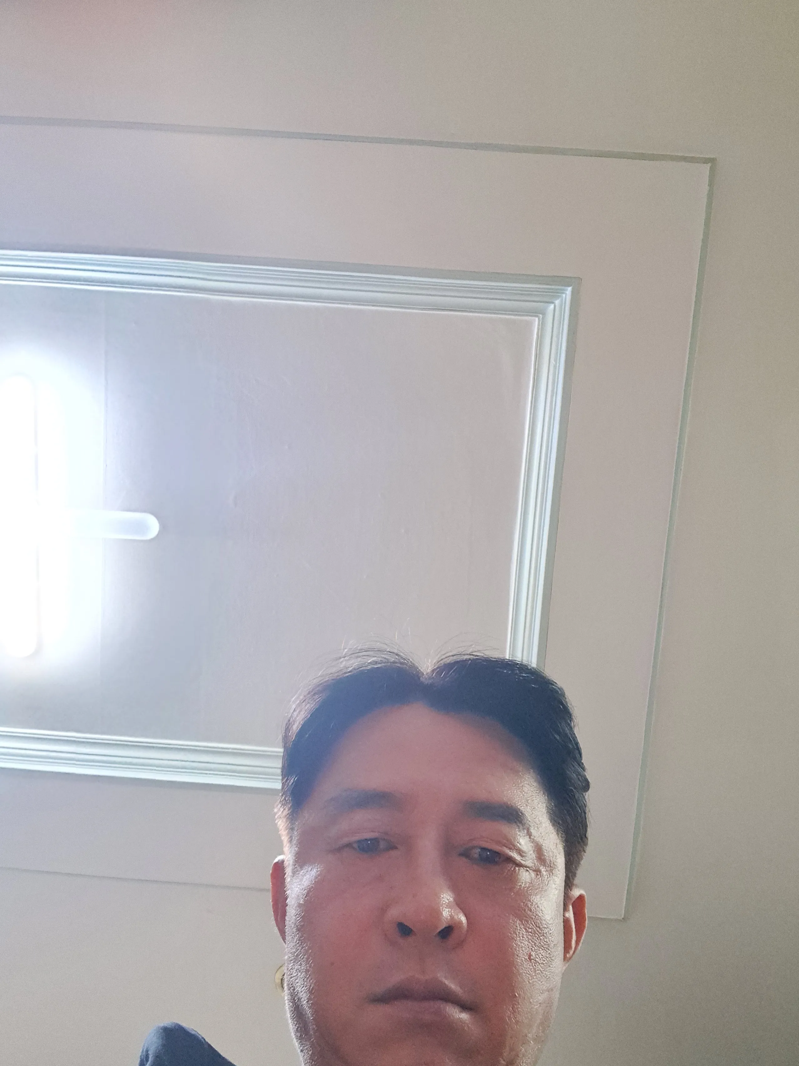 시술 전 — 팔자필러 1cc 3.8만원