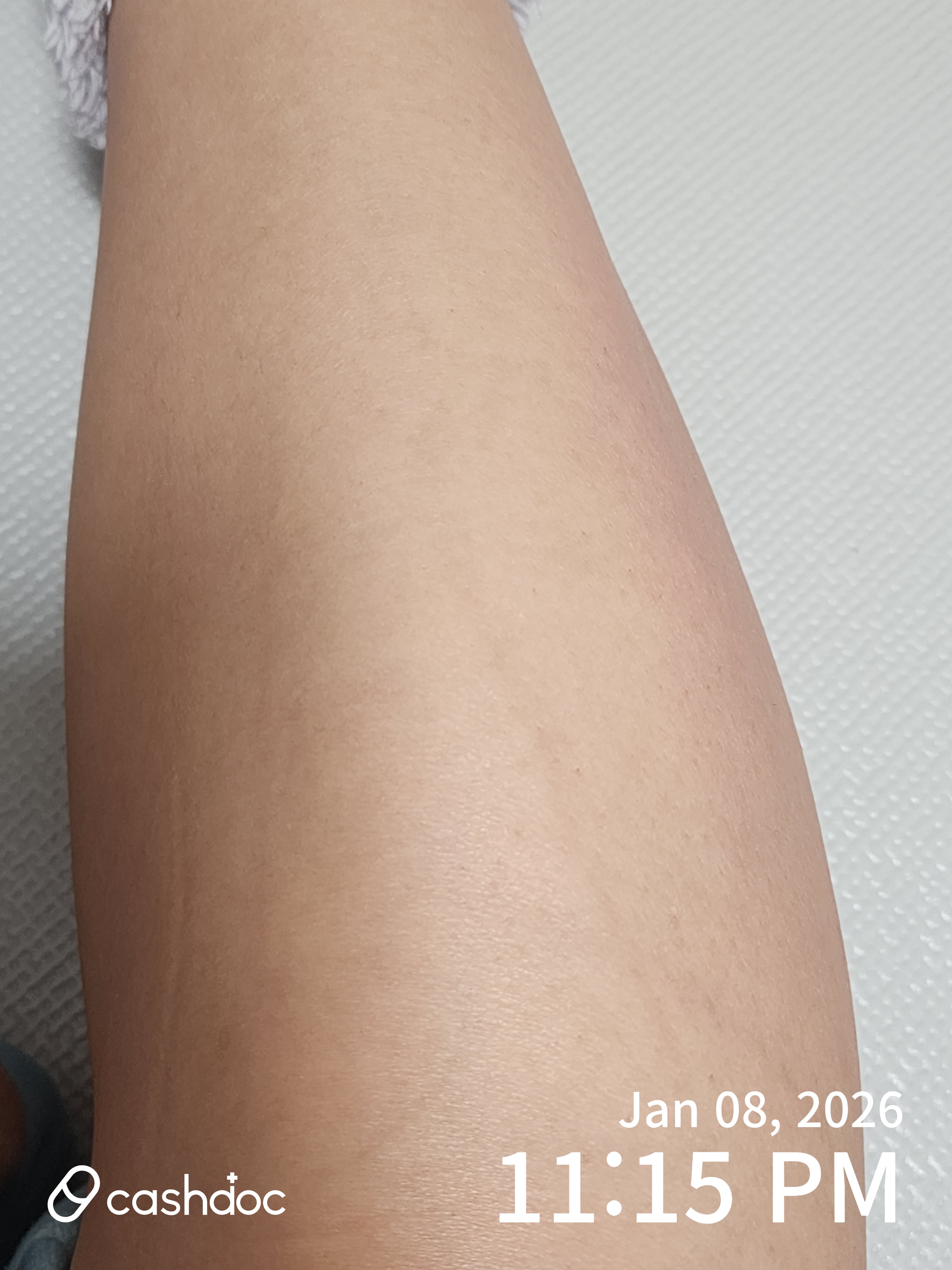 강남구 모리스의원에서 편안하게 빠른 제모 시술 경험