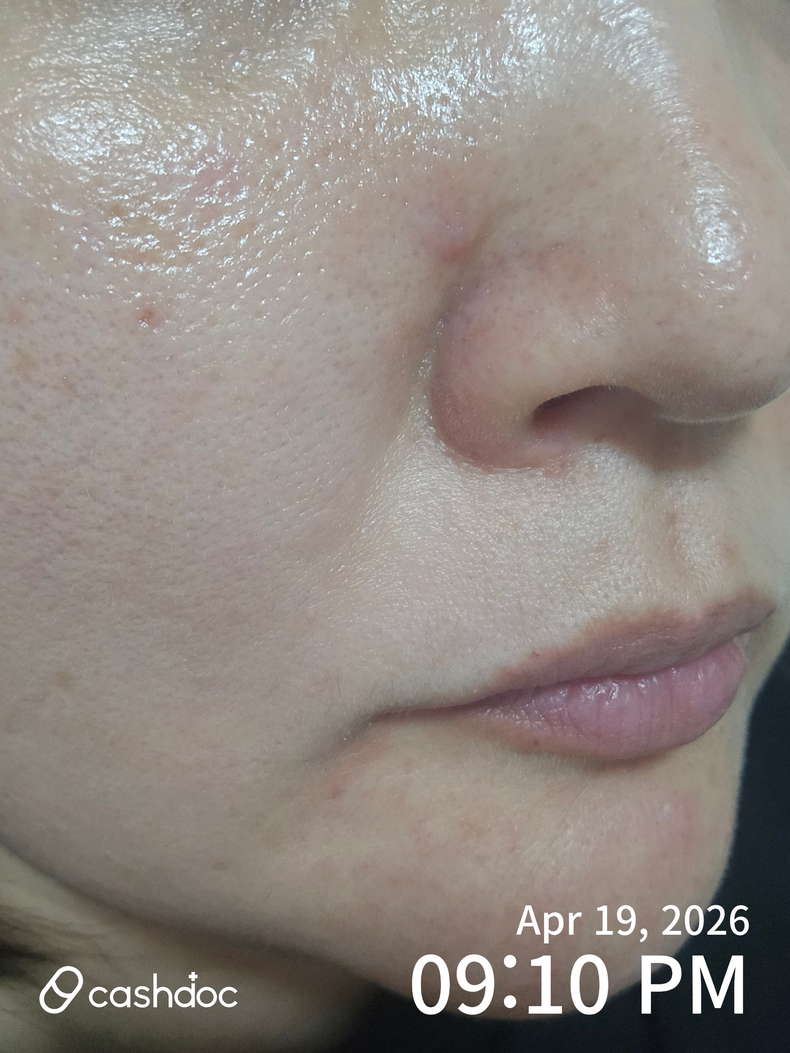 안산시 정환교피부과에서 접촉성 피부염 치료 후기