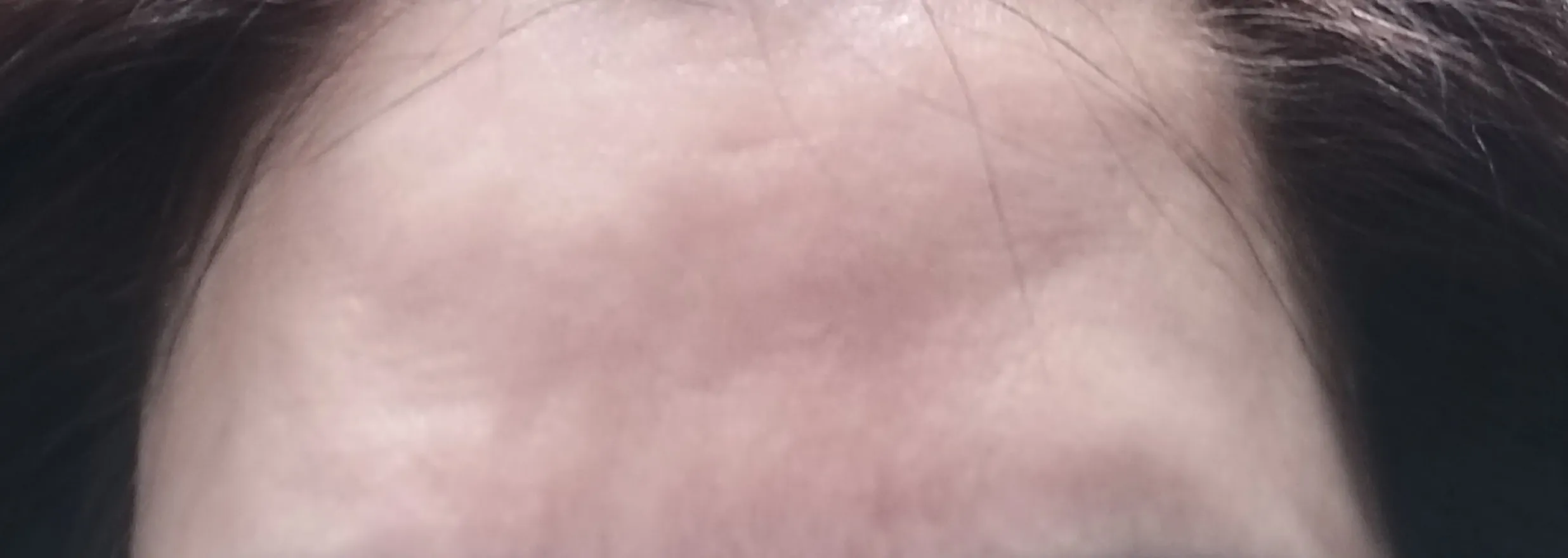 Before treatment — Ribbon Youth Injection Rejuran Healer