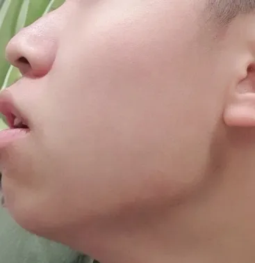 시술 전 — 잘생김에 기준! 남자 코성형