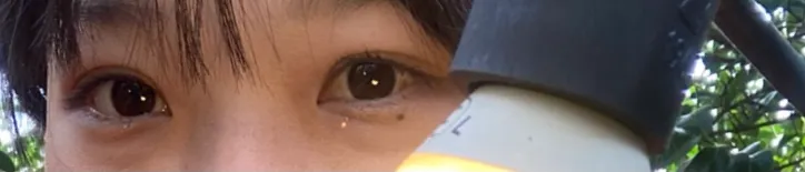 项目前 — 激光眼下脂肪重塑