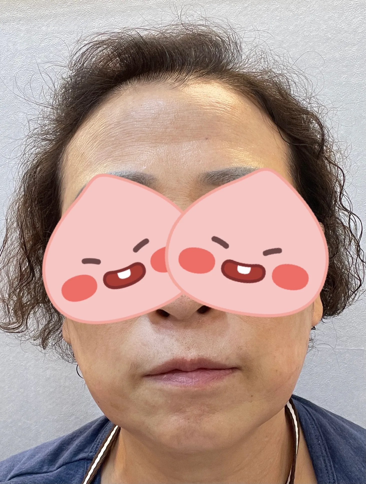 시술 전 — 기미/색소 완벽파괴! #대세 피코토닝
