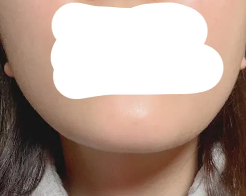 Before treatment — Wonjin_Facial Contouring