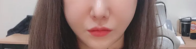 시술 후 — 팔자주름 더블리프팅
