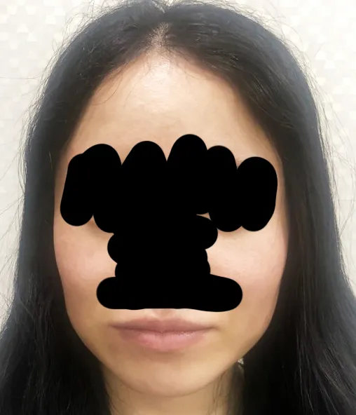 Before treatment — Wonjin_Facial Contouring