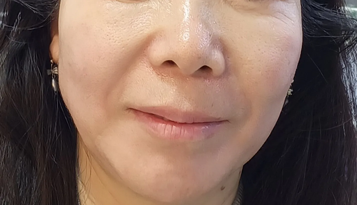 시술 후 — 미케이 피부 탄력개선_슈링크 300샷