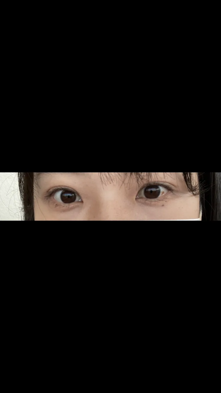 项目后 — 激光眼下脂肪重塑