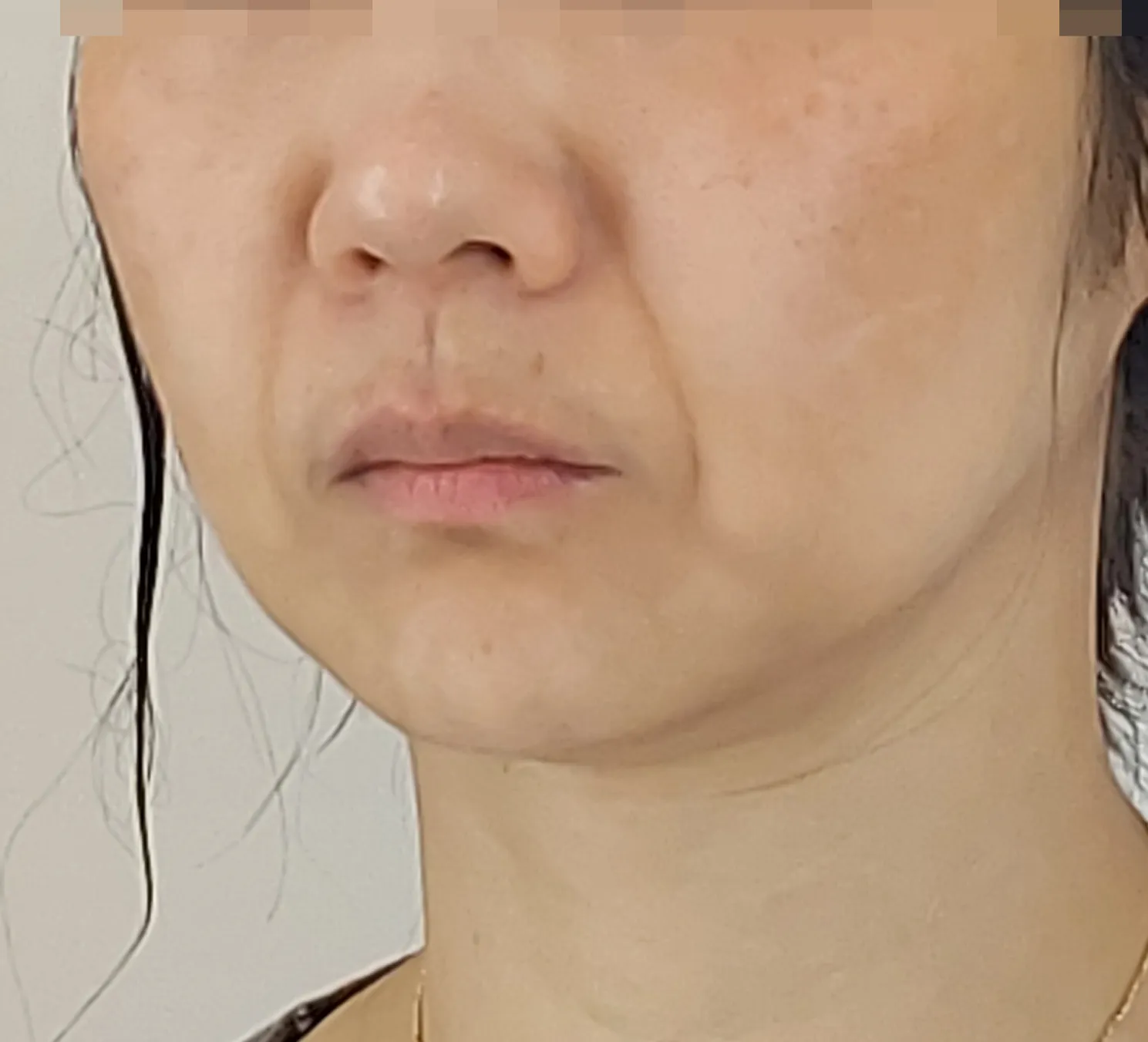시술 전 — 어려지는 동안 실리프팅