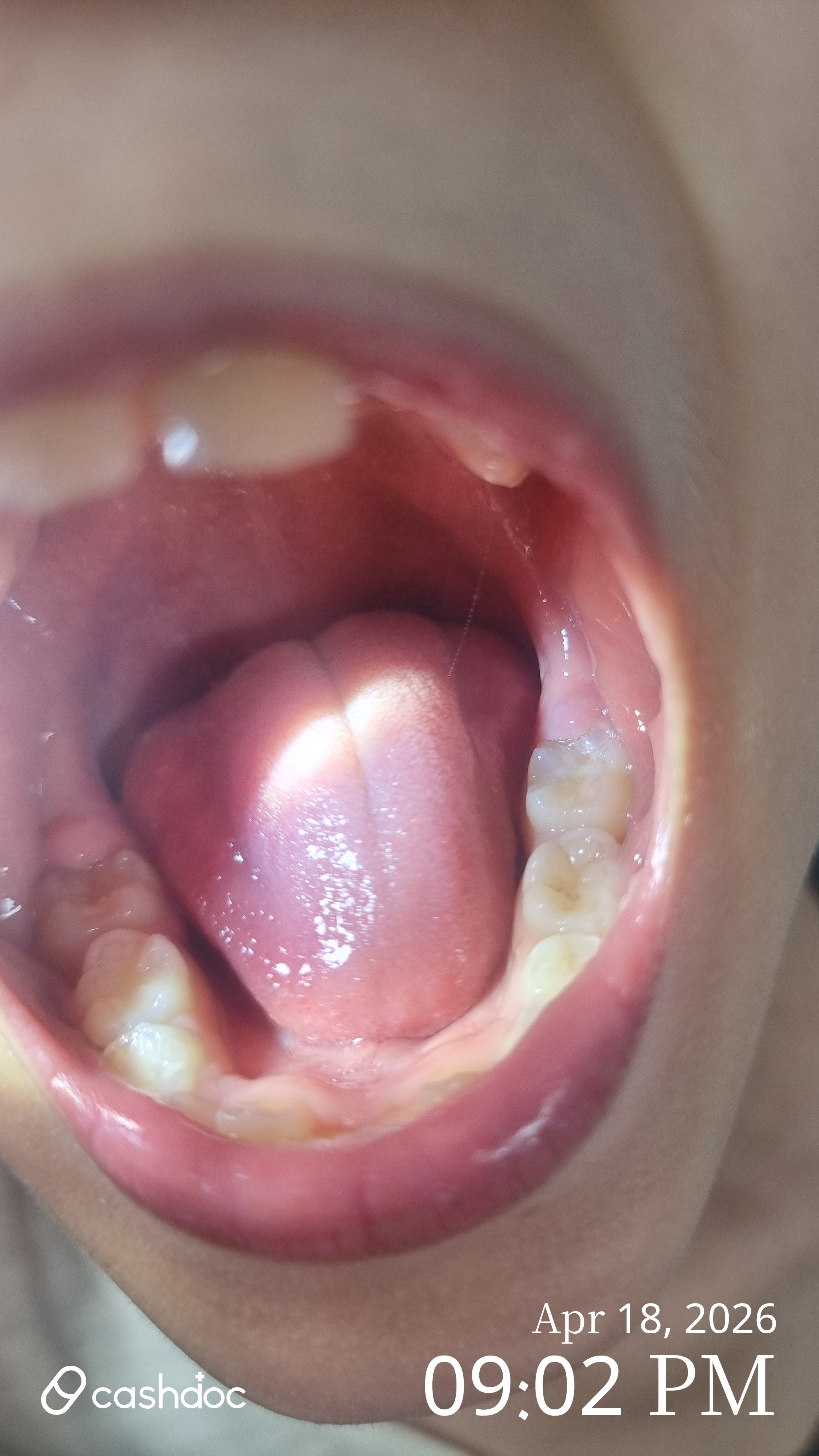 영등포구 키즈웰소아치과에서 아이들 어금니 메우기 완료!