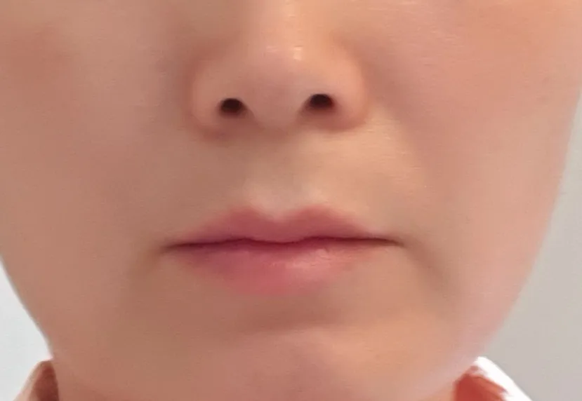 시술 전 — 섹시큐티 입술반영구화장!