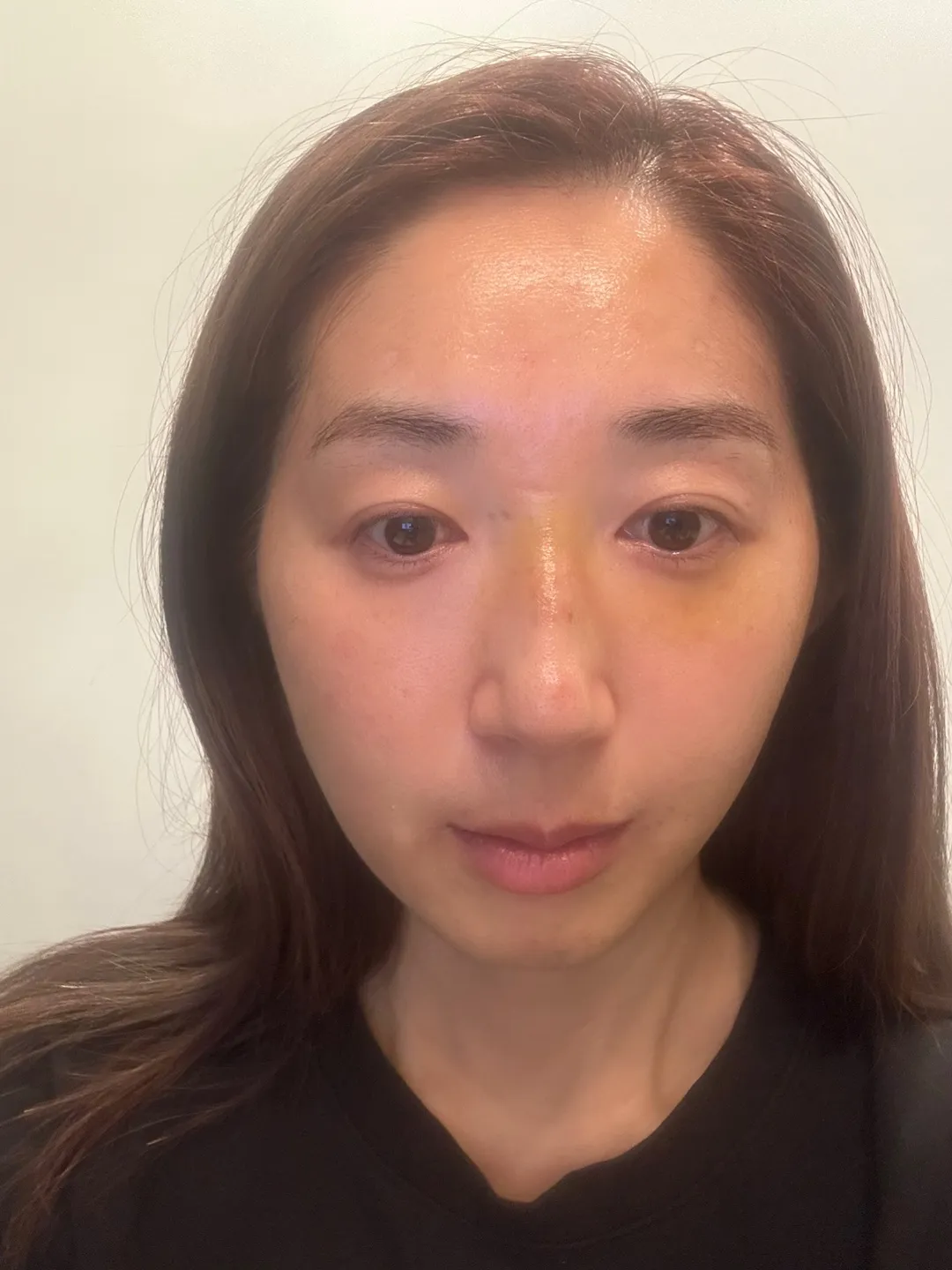 Before treatment — Wonjin_Facial Contouring