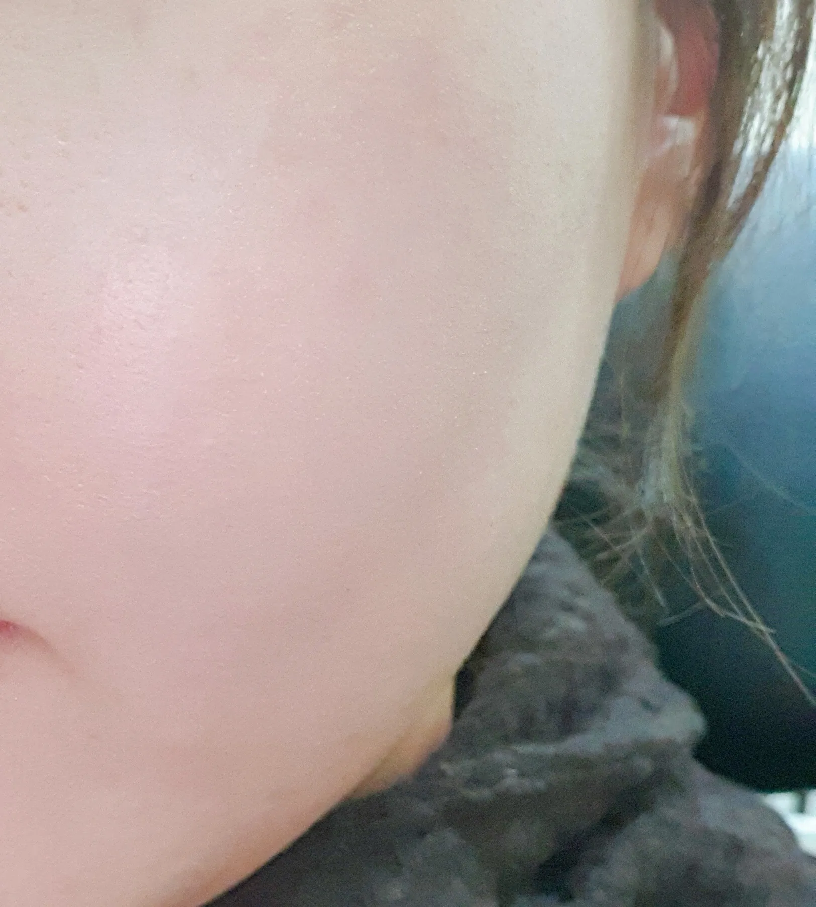 After treatment — ★ Rejuran Healer 7.9 ★ Pore Reduction, Skin